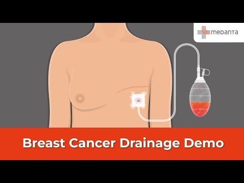  Demo of Using Breast Cancer Drainage After Surgery at Home (Hindi) 